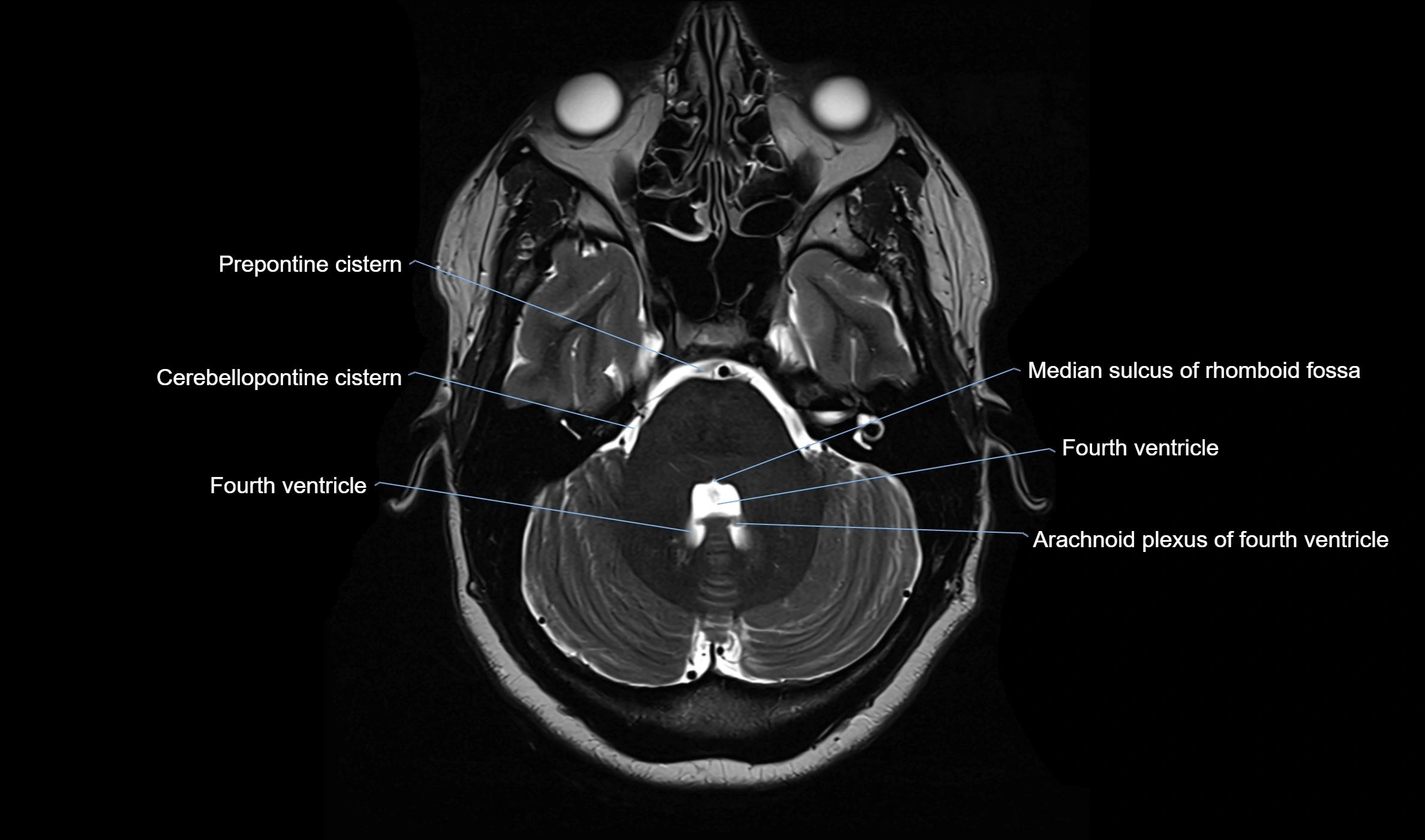 Brain cisterns  and ventricles  axial anatomy 3T MRI image-img-00001-00014.webp